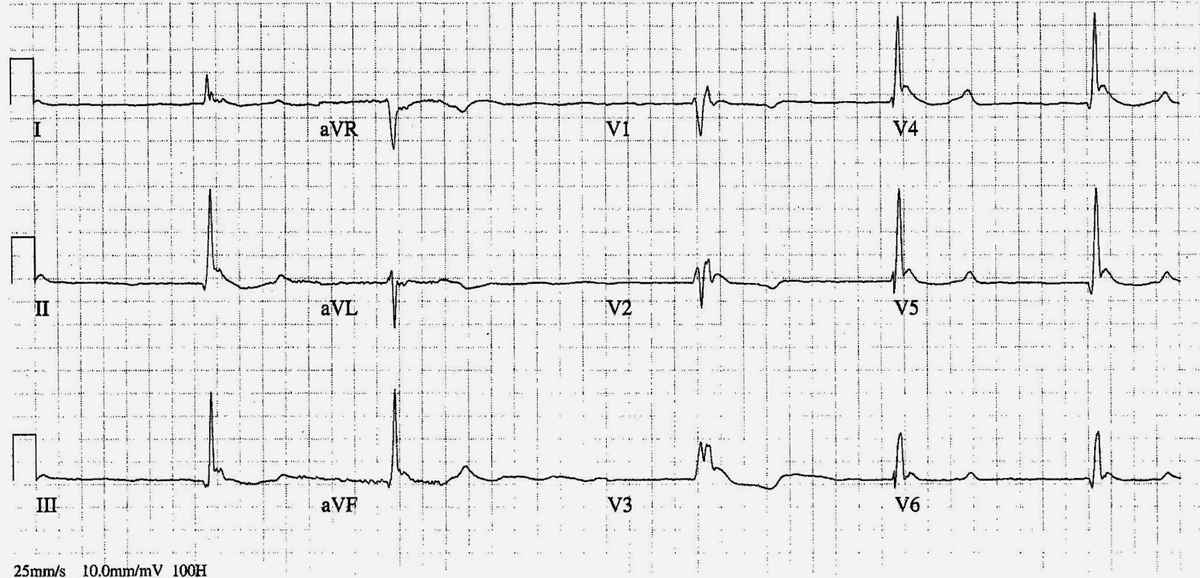 ECG: Hypothermia (Bradycardia, Slow atrial fibrillation, J waves (Osborn wave), QT Prolongation)