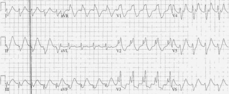 Read more about the article ECG Case 190