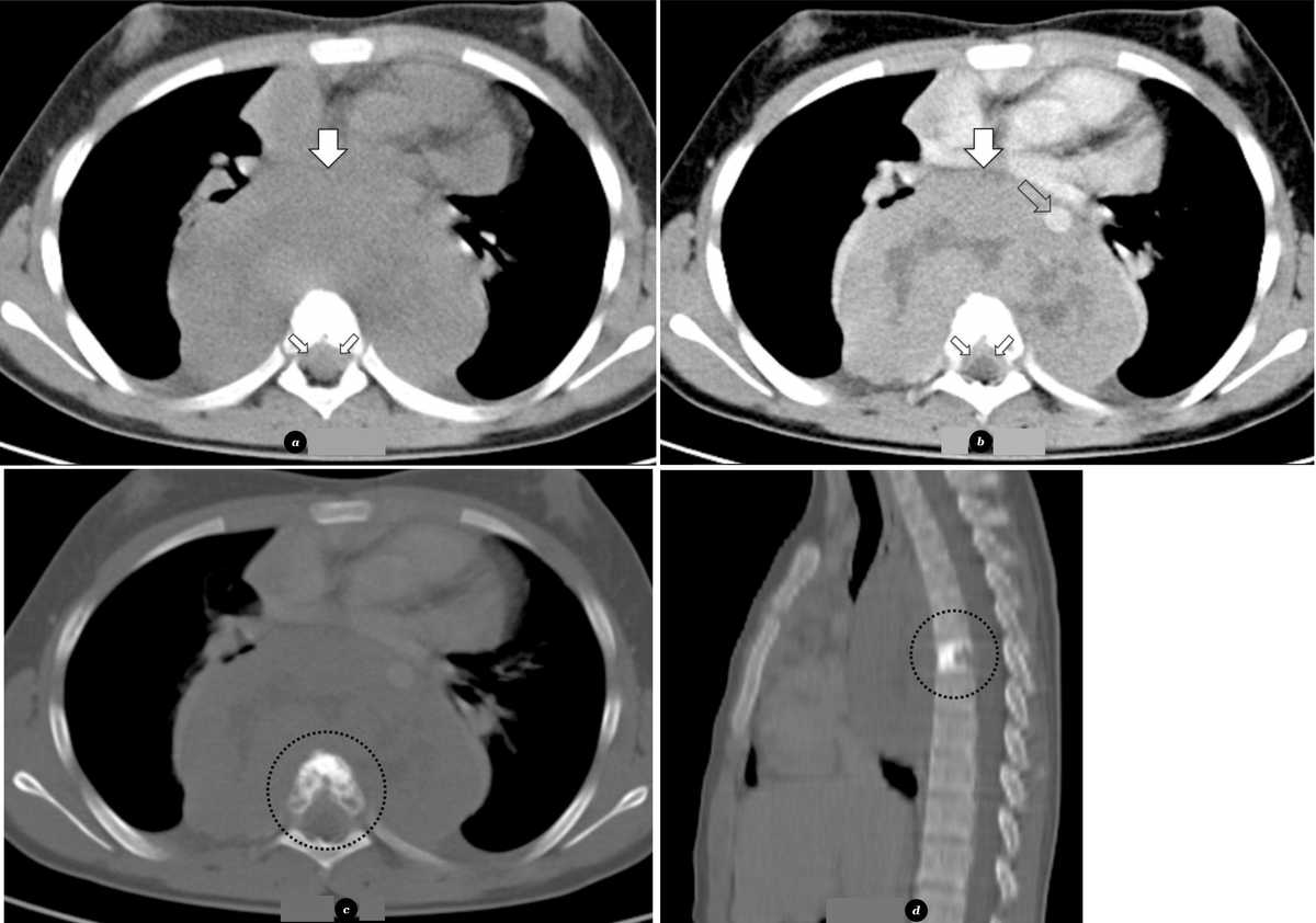 (a) Axial nonenhanced, (b) axial contrast-enhanced, (c) axial bone window and (d) sagital reformation bone window CT images shows a large heterogeneously enhancing mass (large arrows) in the posterior mediastinum, adjacent to the thoracic vertebral bodies, that compresses the heart and encases the descending aorta (open arrow). There is extension to the spinal canal (small arrows), as well as permeative destruction and osteoclerosis of the 6th thoracic vertebral body (circle).