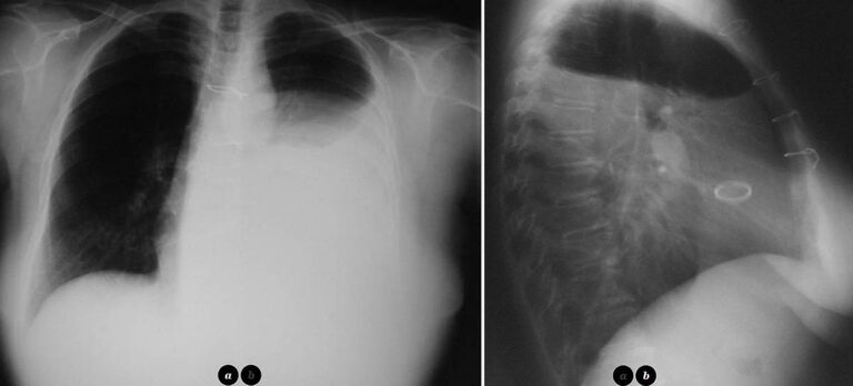 Read more about the article Patient with Chest Pain, Dyspnea, Palpitations and Cough
