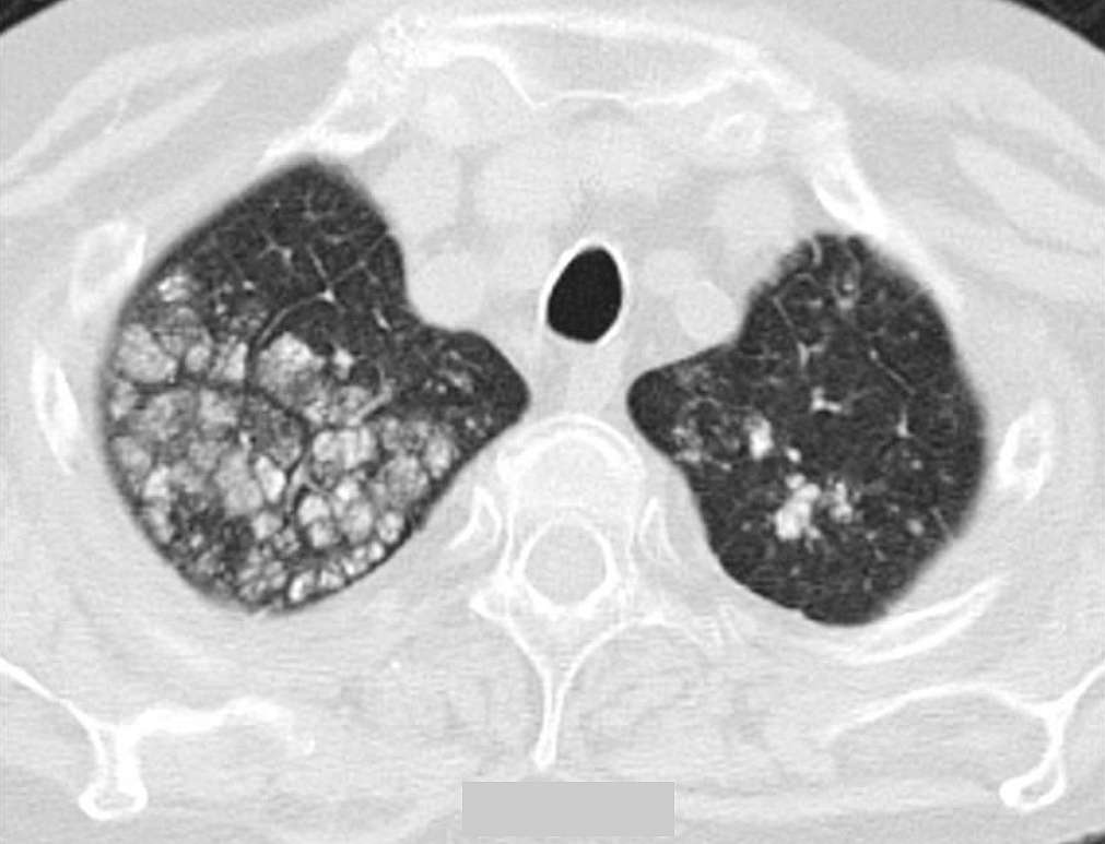 Chest CT showing multiple nodular, centrilobular and calcified lesions in the right and left upper lobe