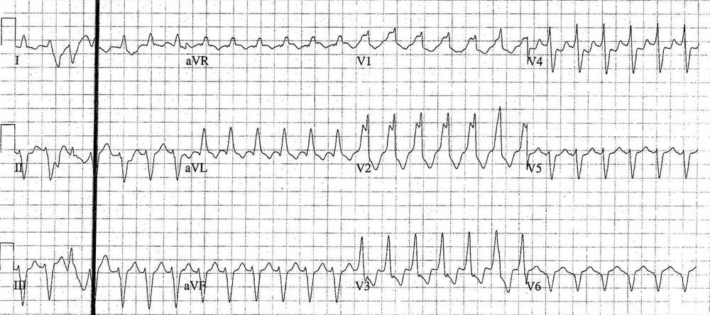 Atrial Flutter 2:1 Block with either pre-existing RBBB or rate-related RBBB