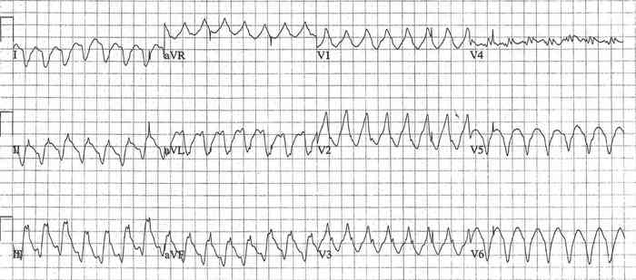 Read more about the article ECG Case 194