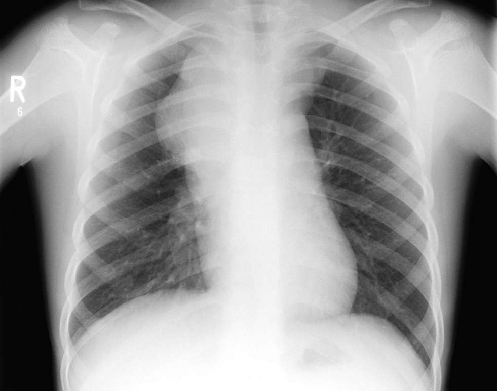 Read more about the article 11-year-old Boy With Retrosternal Chest Pain