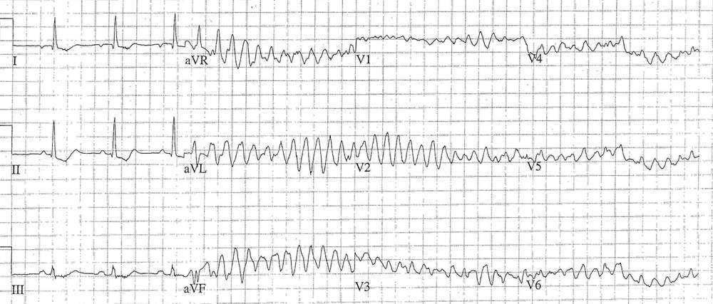 Ventricular Ectopic with 'R-onT' phenomenon causing Polymorphic VT then VF
