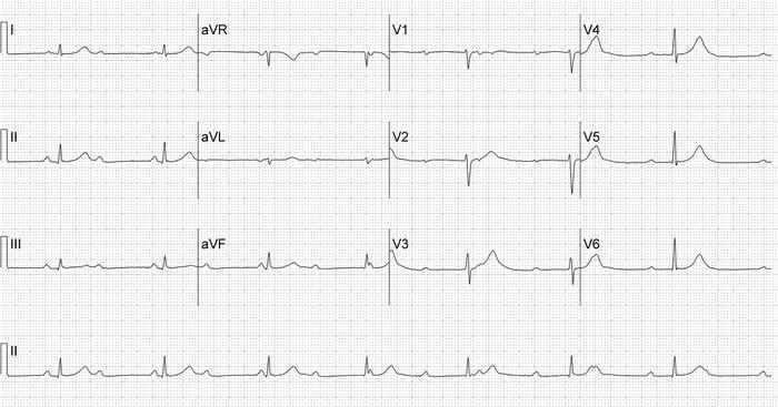 Read more about the article ECG Case 198