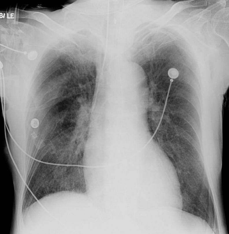 Supine chest X-ray obtained 2 days later showing rapid resolution of the previously seen upper zonal opacities