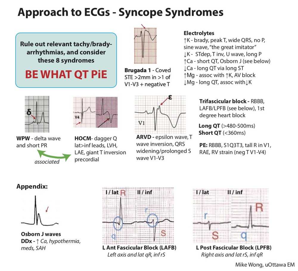 Approach and interpretation of ECG in Syncope