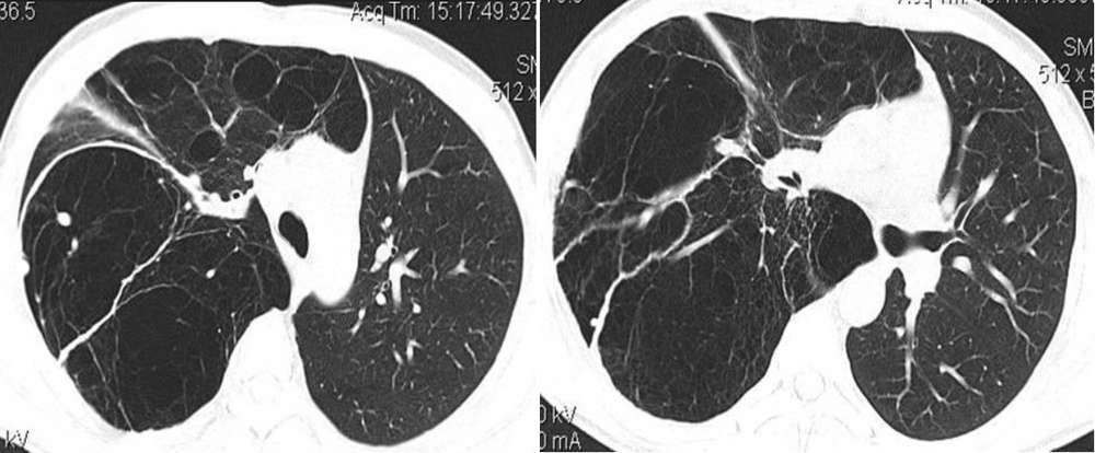 Chest CT scans confirm an abnormal right lung with extensive and well-defined cystic lesions