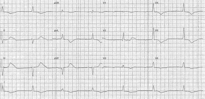 Read more about the article ECG Case 200