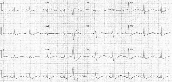 Read more about the article ECG Case 201