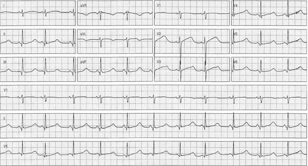 ECG showing Marked QT Prolongation secondary to toxic ingestion