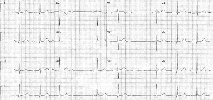 Read more about the article ECG Case 203