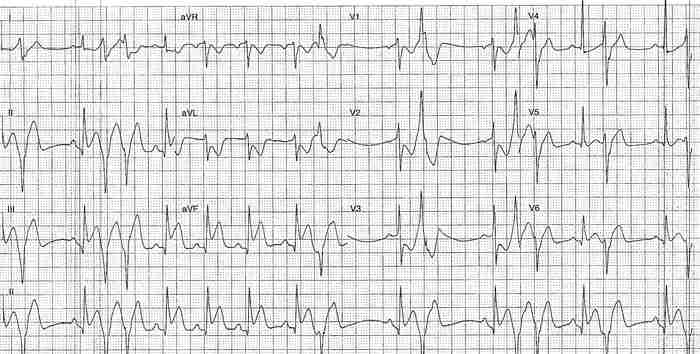 Read more about the article ECG Case 204
