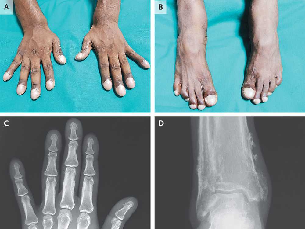 Read more about the article Progressive Fingertip and Toe Enlargement
