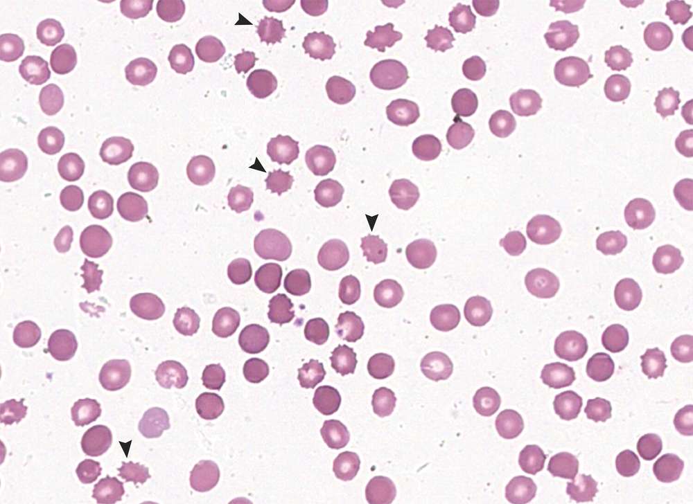 A peripheral-blood smear showed red cells lacking central pallor with irregularly distributed surface projections, features that are consistent with acanthocytes, or spur cells (arrowheads)