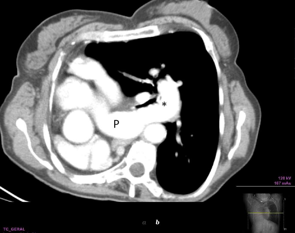 On mediastinal windowing there is a complete absence of the right lung parenchyma. Note the main pulmonary artery (P) giving rise to left pulmonary artery (asterisk) and absence of the right pulmonary artery. The heart and great vessels are clearly displaced to the right.