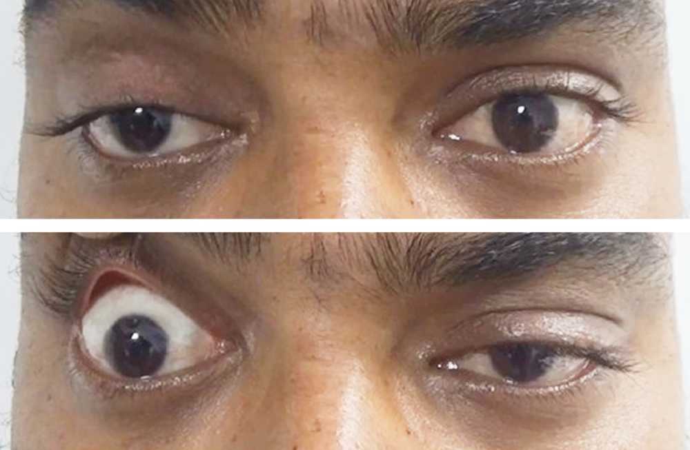 Read more about the article Double Vision and Eyelid Drooping