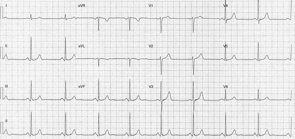 Resolution of the inferior T wave abnormalities with a normal p wave axis