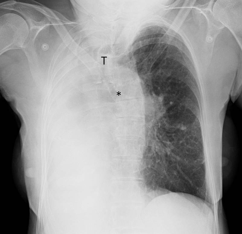 There is complete opacification of the right hemithorax with volume loss and an ipsilateral shift of the mediastinum. The trachea (T) is displaced to the right and the left main bronchus is depicted (asterisk).