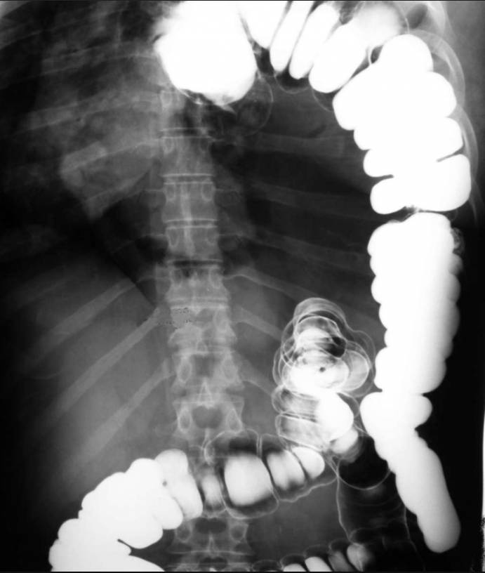 Double-contrast barium enema showing displacement of the large intestine into the left hemithorax