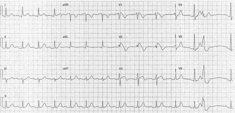 Brugada Syndrome Type 1 Pattern