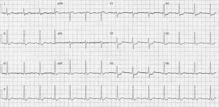 Read more about the article ECG Case 211