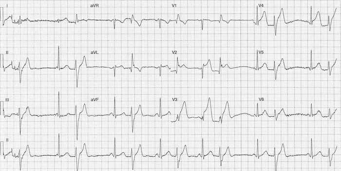 Read more about the article ECG Case 212