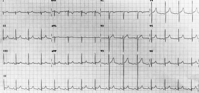 Read more about the article ECG Case 213
