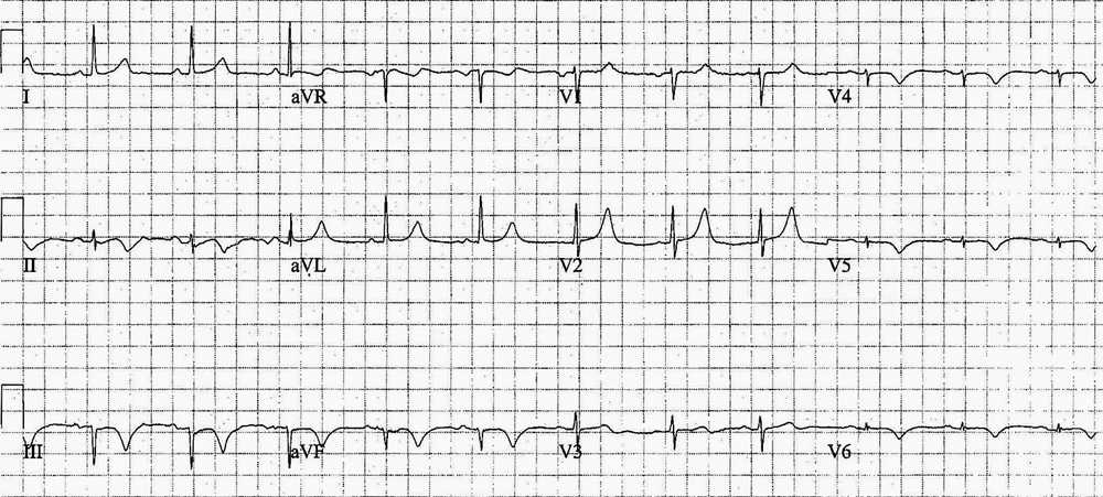 ECG shows ischemia with re-perfusion (deep T wave inversion)