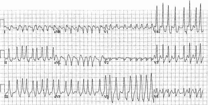 Read more about the article ECG Case 215