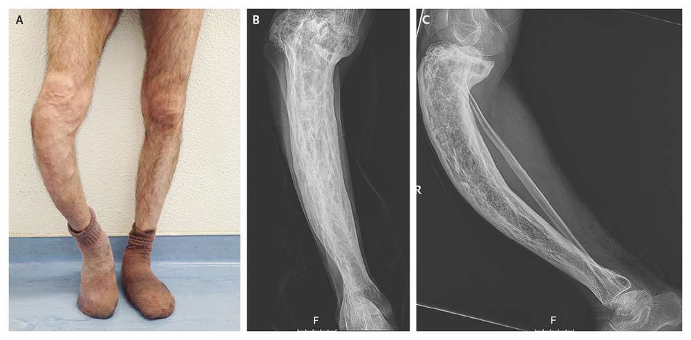 Saber Tibia in Paget's Disease of Bone