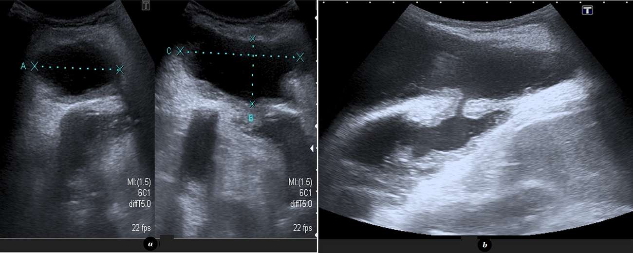 Ultrasound image demonstrates a large subcutaneous collection with fine internal debris (a), and communication between large subcutaneous collection and pleural effusion (b)