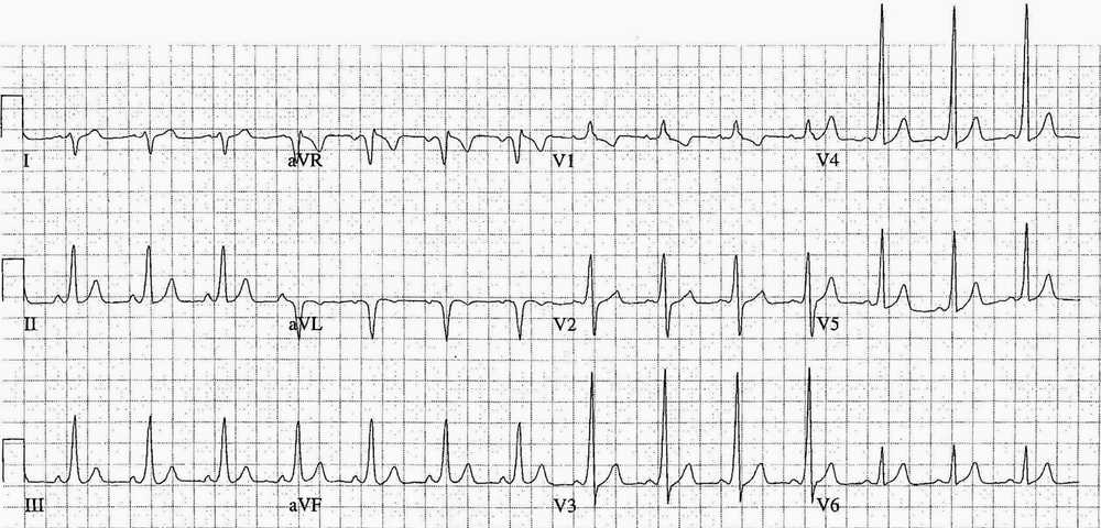 This ECG shows WPW as evidence by short PR interval, QRS prolongation, and delta waves (best appreciated in leads V3-5)