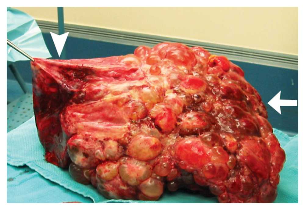 Liver Transplantation for Polycystic Liver Disease