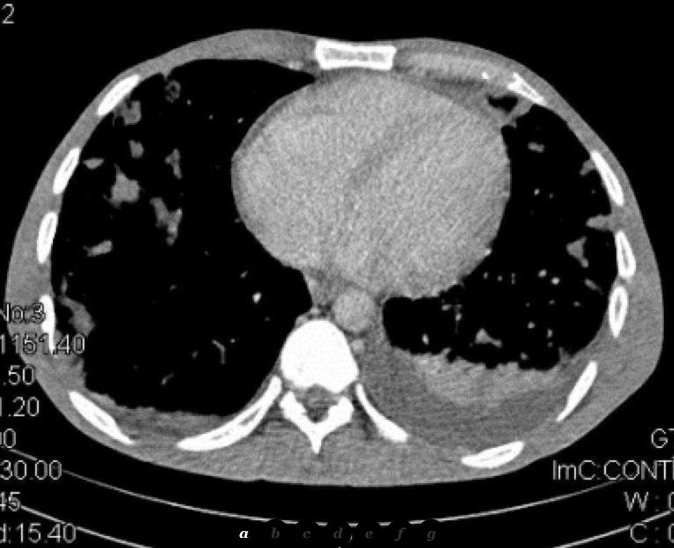 Axial chest CT on soft tissue windowing showing a small left pleural effusion along with multiple nodules.
