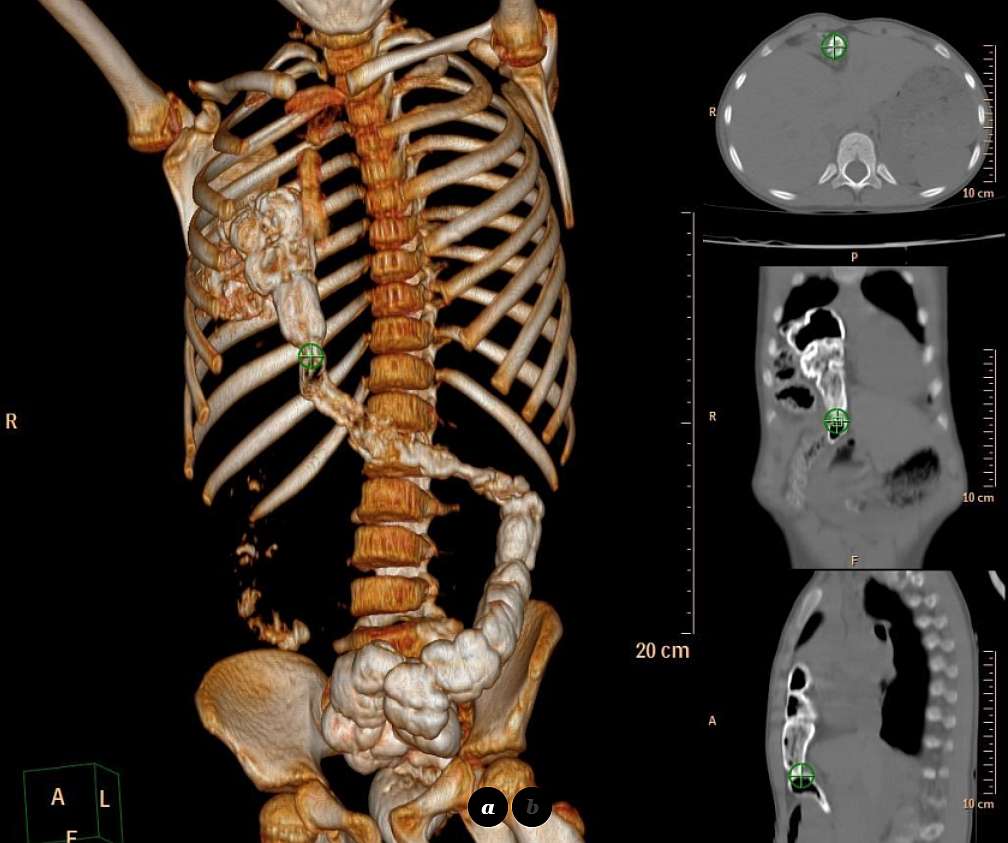 CT 3D volume rendering and MIP recontruction: Note the hepatic flexure and the major part of transverse colon inside the right chest