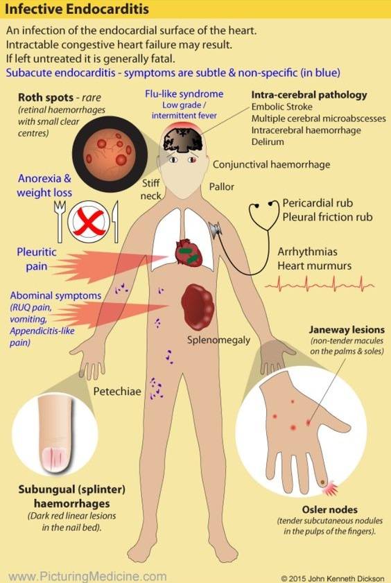 Clinical Features (Symptoms and Signs) of Infective Endocarditis