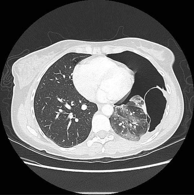 Contrast enhanced CT thorax demonstrating an air-filled cyst in the left lower zone and a moderately sized left-sided pneumothorax.