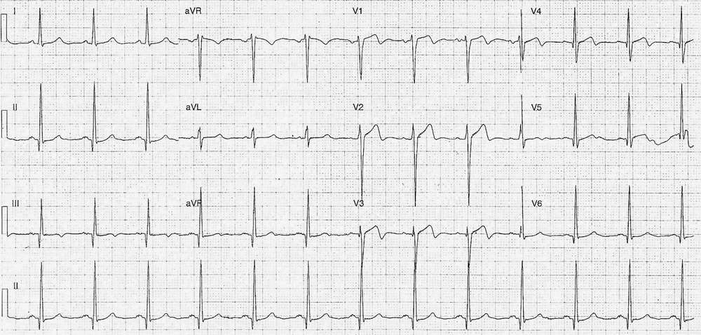 Wellens' Syndrome (type 2)