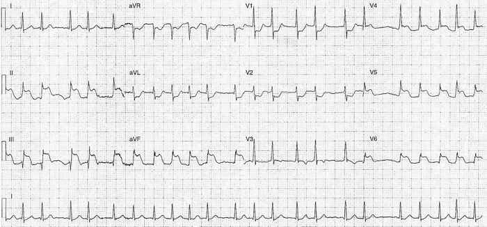 Read more about the article ECG Case 217