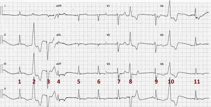 Read more about the article ECG Case 218