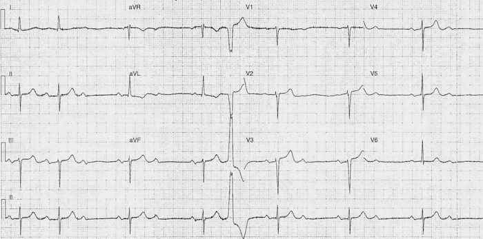 Read more about the article ECG Case 219