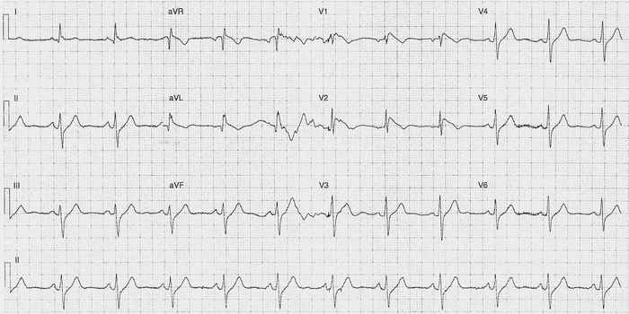 Read more about the article ECG Case 221