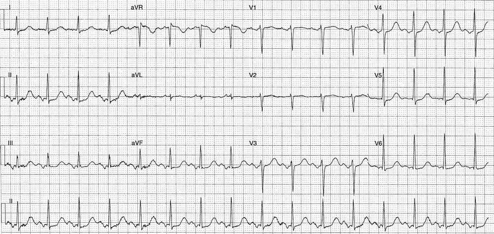 ECG Case 220 Interpretation - Manual of Medicine