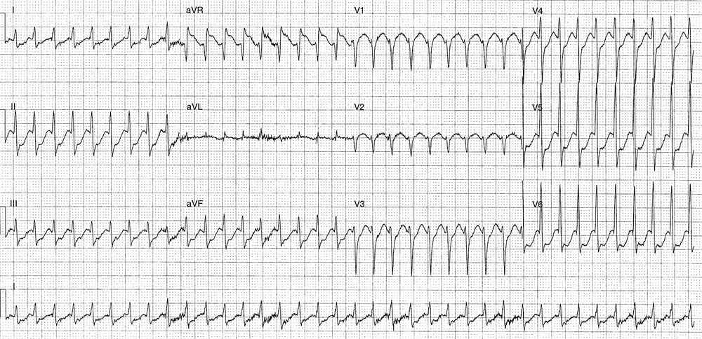 ECG showing AVNRT