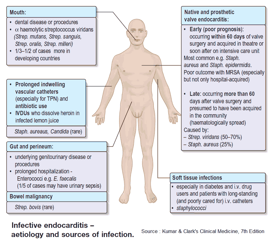 Infective endocarditis - etiology and sources of infection