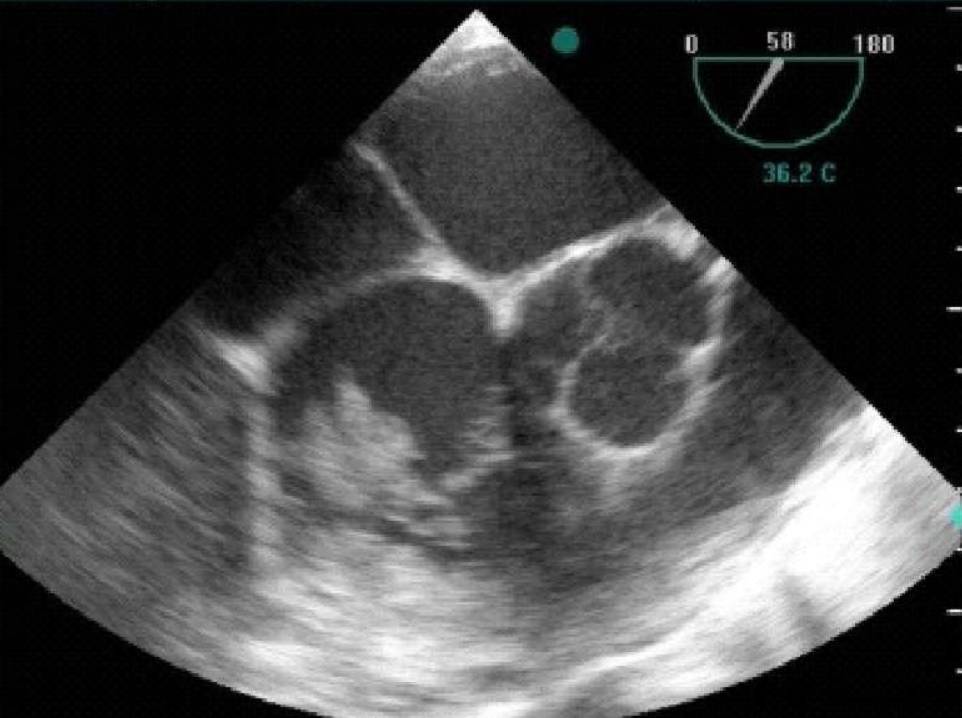 Transesophageal cardiac ultrasonography revealed vegetations in the tricuspid valve