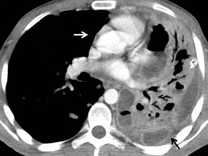 Chest CT showing left loculated pleural effusion with thickening and enhancement of parietal and visceral pleura (black arrow). In addition, ipsilateral mediastinal shift is produced (white arrow).