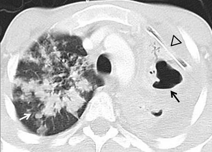 CT Lung window setting reveals consolidations with cavities in the collapsed left lung (black arrow). The right upper lobe presents multiple consolidations (white arrow). Tube thoracostomy is positioned in the left pleural space(arrowhead).